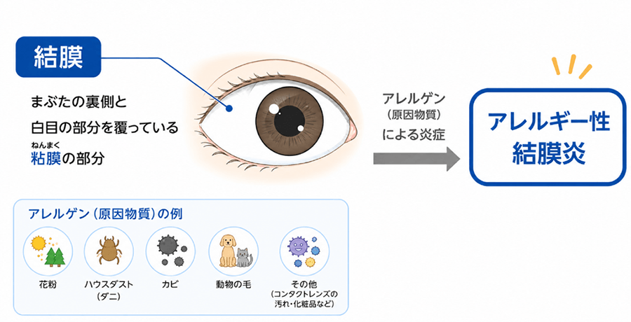 結膜がアレルゲン（原因物質）による炎症を起こし、アレルギー性結膜炎になる