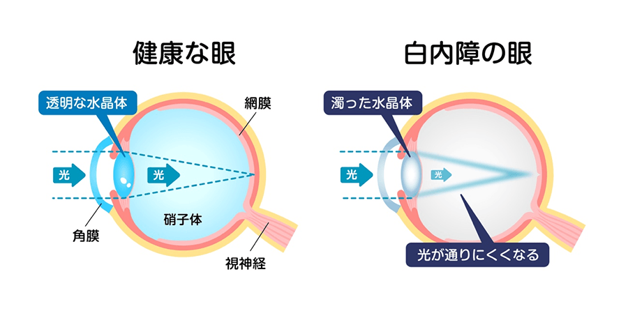 健康な眼と白内障の眼の比較