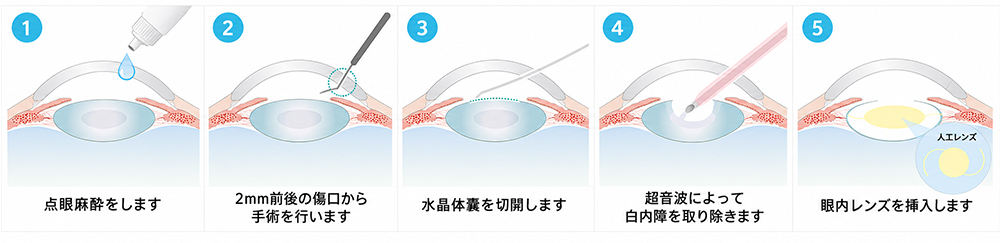 白内障手術の流れ
