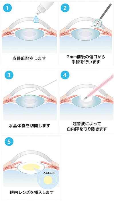 白内障手術の流れ