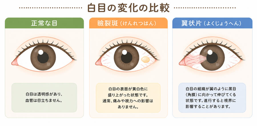 白目の変化の比較：正常な目、瞼裂班（けつれんはん）、翼状片（よくじょうへん）