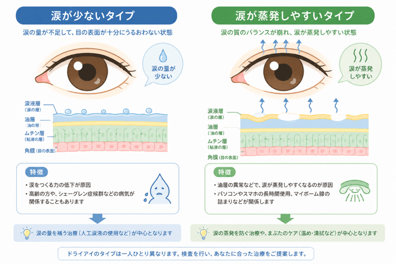 涙が少ないタイプ：涙の量が不足して、目の表面が十分にうるおわない状態。涙が蒸発しやすいタイプ：涙の質のバランスが崩れ、涙が蒸発しやすい状態。
