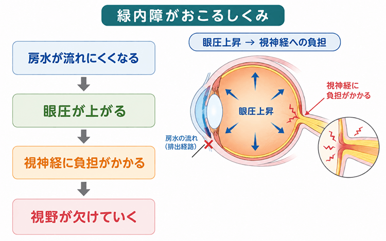 緑内障がおこるしくみの図