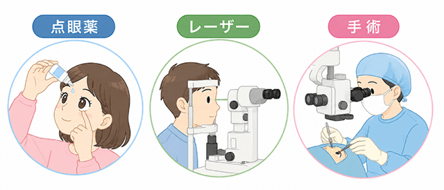 点眼薬・レーザー・手術