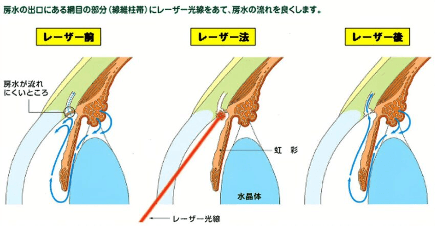 房水の出口にある網目の部分にレーザー光線をあて、房水の流れを良くします。