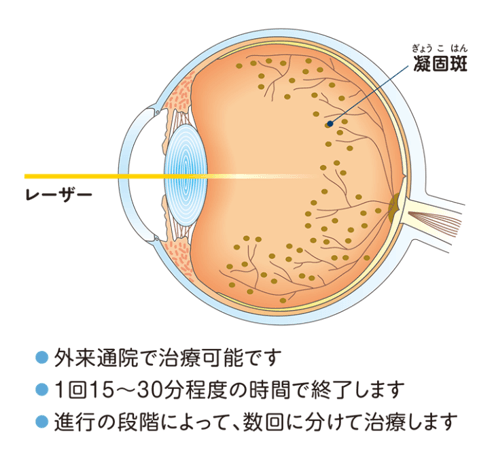 外来通院で治療可能です。1回15～30分程度の時間で終了します。進行の段階によって、数回に分けて治療します。