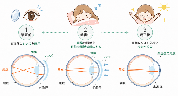 寝る前にレンズを装用←角膜の形状を正常な屈折状態にする→翌朝レンズを外すと視力が改善