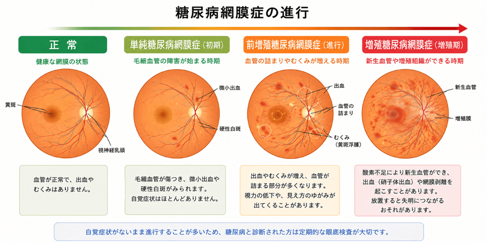 糖尿病網膜症の進行