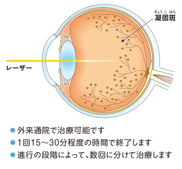 外来通院で可能です。1回15～30分程度の時間で終了します。進行の段階によって、数回に分けて治療します。