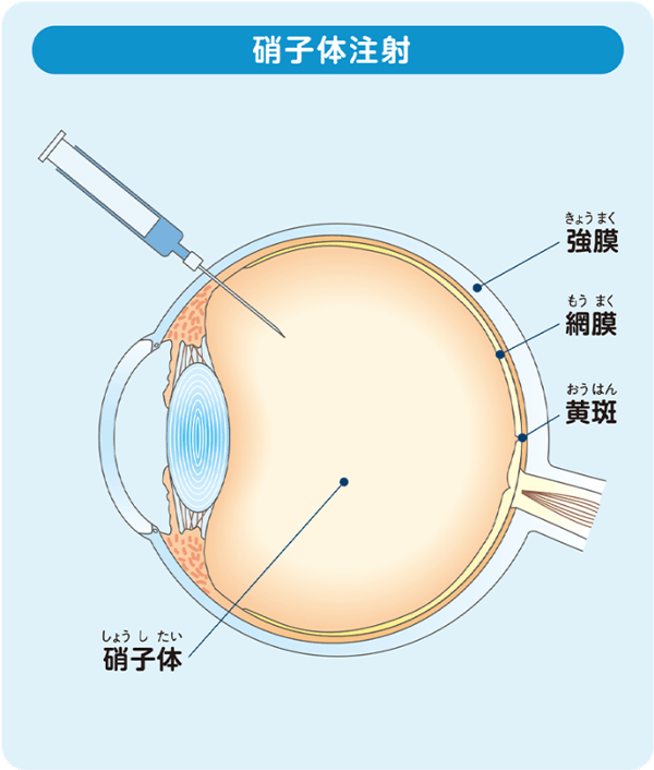 硝子体注射