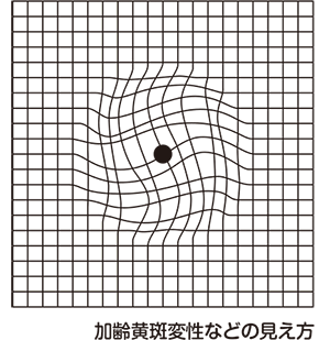アムスラーチャートの加齢黄斑変性などの見え方