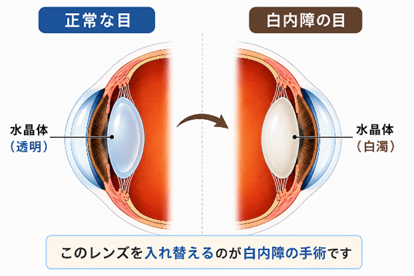 水晶体のレンズを入れ替えるのが白内障の手術です