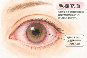 毛様充血：目のまわりに放射状の赤み