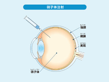硝子体注射