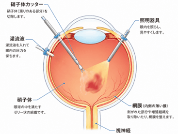 硝子体手術の手順