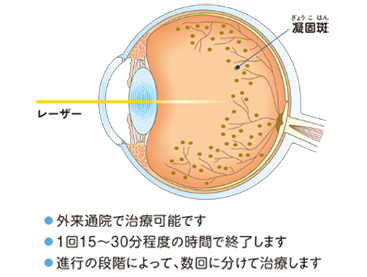 外来通院で可能です。1回15～30分程度の時間で終了します。進行の段階によって、数回に分けて治療します。